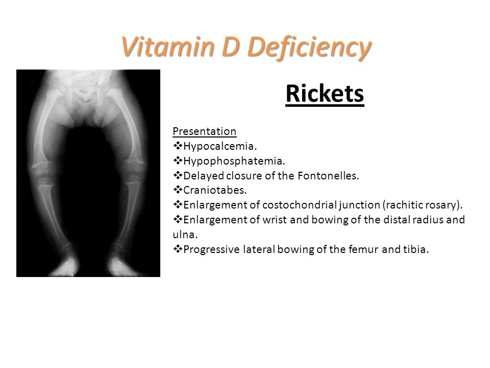 Vitamin d and nutritional rickets
